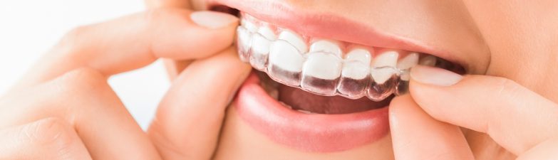Does Invisalign Work? What are its Benefits?